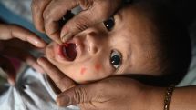 Measles cases and deaths rise worldwide, report warns