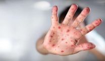 41 measles cases confirmed in Armenia in January