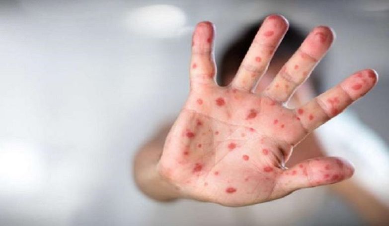 41 measles cases confirmed in Armenia in January